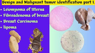 Leiomyoma of Uterus Fibroadenoma of breast Breast Carcinoma Lipoma identificationPatho exam OSPE [upl. by Noimad]