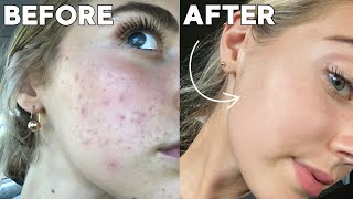 How I Cleared My Skin In 8 Weeks naturally [upl. by Gustafson8]