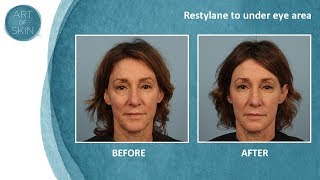 Undereye filler with Restylane Dr Palm San Diego [upl. by Suhsoj292]