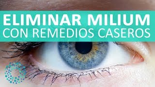 Cómo eliminar MILIUM con REMEDIOS CASEROS [upl. by Dianne782]