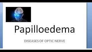 Ophthalmology Papilledema amaurosis fugax sometimes loss of vision cant see Hayreh theory [upl. by Hebel831]