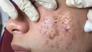 Make your Acne Treatment Huong Da Nang  453 acne 2022 [upl. by Aicitan886]