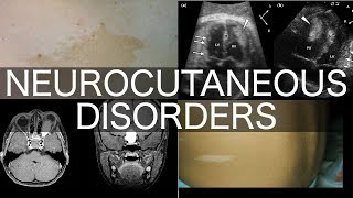 Neurocutaneous Disorders [upl. by Ayanej]