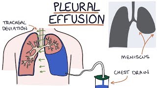 Understanding Pleural Effusions [upl. by Ami]