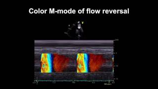 Echocardiography Essentials Detecting aortic regurgitation [upl. by Etteraj]