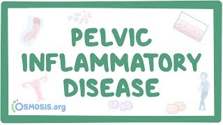 Pelvic inflammatory disease  causes symptoms diagnosis treatment pathology [upl. by Elamor222]