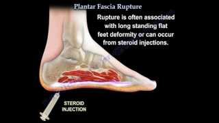 Plantar Fascia Rupture  Everything You Need To Know  Dr Nabil Ebraheim [upl. by Plath890]