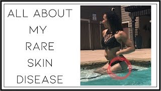 All About My Rare Skin Disease  Linear Morphea Scleroderma Health Series [upl. by Ringler162]