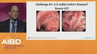 Challenges in the treatment of severe Crohns disease [upl. by Fokos]