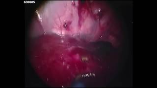 Patches Keyhole Surgery YT [upl. by Elokcin603]