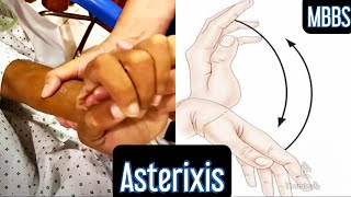 Asterixis Flapping Hand Tremor [upl. by Adnirem]