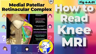 Fig 4A01 Anatomy of the Medial Patellar Retinacular Complex Part 1 [upl. by Hyrup]