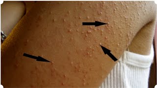 How To Get Rid of Keratosis Pilaris  Chicken Skin [upl. by Eirret]