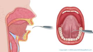 My Tongue Tied Friend  Lingual Frenectomy by Newport Beach Dentist Dr Andrew Spath [upl. by Lyndell]