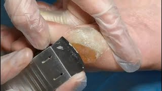 SO SATISFYING Do you wanna watch this  Cracked heel treatment amp Callus removal [upl. by Uliram228]