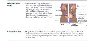 6 Posterior urethral valves and Vesicoureteral reflux  USMLE STEP 1 [upl. by Aicilegna709]