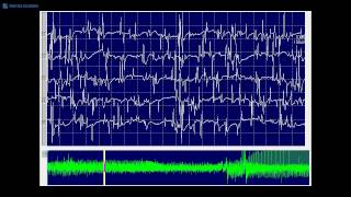 Kimura amp Kohara F20 Myotonic discharges mixed with spontaneous single muscle fiber discharges [upl. by Fiedling89]