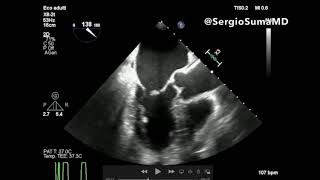 MITRAL REGURGITATION TRANSESOPHAGEAL ECHOCARDIOGRAPHY TEE  CASE 4 [upl. by Hooker]