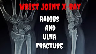 Wrist joint Xray  Radius and ulnar styloid process fracture [upl. by Odnamla]