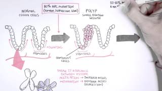 Colon Cancer Carcinogensis [upl. by Mireille]