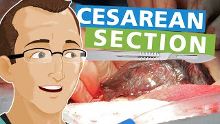 Cesarean Section [upl. by Einrae]