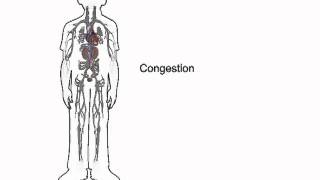 How heart failure causes fluid accumulation  wwwheartfailuremattersorg [upl. by Auqinom]