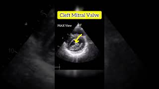 Cleft Mitral Valve Echocardiogram echocardiography mitral heart [upl. by Buff]