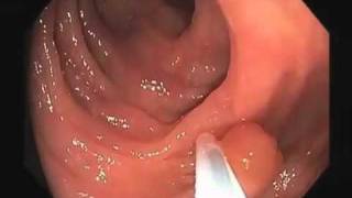 Colonoscopy Video Tour Removal of a Colon Polyp Polypectomy [upl. by Ahsinit]