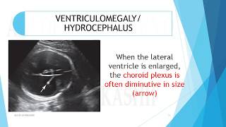 VENTRICULOMEGALYHYDROCEPHALUS A2Z of Ultrasound [upl. by Sokem]