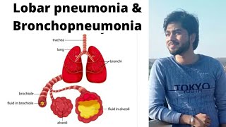 Pneumonia  Lobar pneumonia and BronchopneumoniaBy Abhishek sir [upl. by Klump]