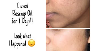 I used Rosehip Oil for 7 Days😧 [upl. by Gorey92]