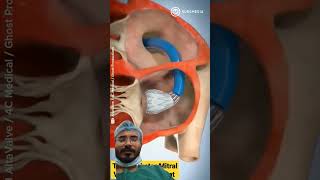 Heart valves replacement surgery medicalanimation anatomy doctor medicalstudent shalyatantra [upl. by Annia]