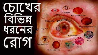 চোখের বিভিন্ন ধরনের রোগ এবং তাদের লক্ষণ16 type of Eye Diseases [upl. by Heyde131]