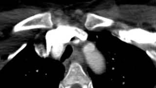 Gated CT Chest Angiography Bicuspid Aortic Valve [upl. by Orwin]