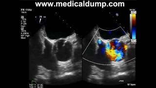 Bicuspid Aortic Valve  Severe Aortic Regurgitation  TransEsophageal Echo TEE [upl. by Telfer]