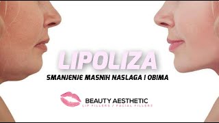 Lipoliza  Beauty Aesthetic Tuzla [upl. by Zetnauq]