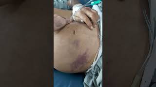 Abdominal distension  Ascites  Patient with DCLD  Clinical skills [upl. by Brahear]