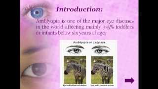 Therapies to cure Amblyopia [upl. by Anauqcaj]