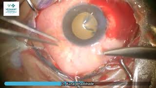 Pterygium excision Conjunctival Autograft Sutureless Glueless [upl. by Skurnik293]