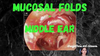 006 Mucosal Folds and spaces of the Middle Ear anatomy of middle ear [upl. by Eiznekcm]