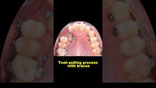 Pulling out hidden teeth when braces braces orthodontist dentist bracesoff [upl. by Esinyl]