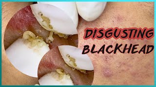 Big Cystic Acne Blackheads Extraction Blackheads amp Milia Whiteheads Removal Pimple Popping [upl. by Neirbo439]