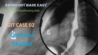 FRCR Radiology  A 60 year old patient presented with progressive dysphagia  GIT Contrast Study 02 [upl. by Relluf]