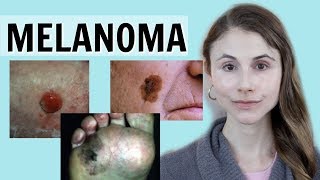 Melanoma skin cancer QampA with dermatologist Dr Dray [upl. by Ruskin894]