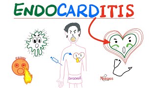 Infective Endocarditis  Fever amp New Murmur  Modified Duke’s Criteria  Cardiology Playlist [upl. by Aihc845]