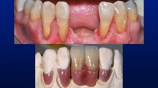 No Prep Gingival Veneers  Best Conservative Solution [upl. by Circosta]