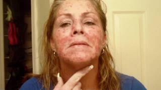 Skin Cancer My VlogJournal Treatment W EFUDEX vid10 [upl. by Mulry]