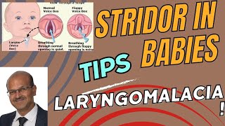 Approach to infants with stridor Laryngomalacia noisy breathing noisybreathing babybreathing [upl. by Ahseyk]