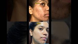 Tretinoin transformation before and after tretinoin tretinoincream shortsfeed face pimple [upl. by Jannelle598]