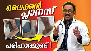 ലൈക്കെൻ പ്ലാനസ്‌നു ഒരു പരിഹാരമാർഗ്ഗം 👍🏼 Lichen planus treatment malayalam DrSuneefHaneefa [upl. by Aramenta]